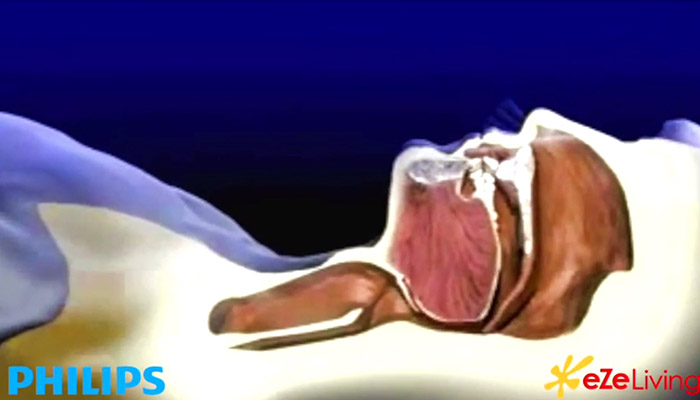 apnea del sue&ntilde;o s&iacute;ntomas