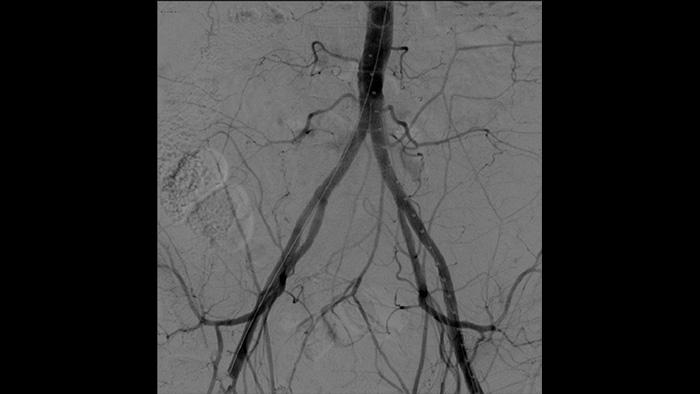 Tratamiento vascular