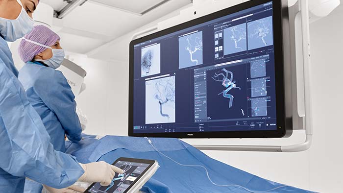 Tratamiento del aneurisma cerebral