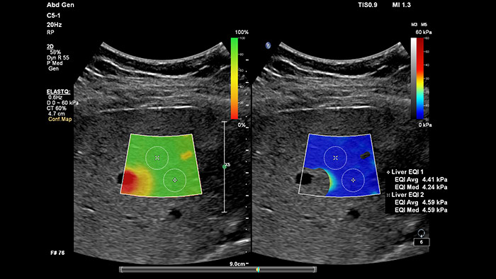 Sistema de ultrasonidos EPIQ 7
