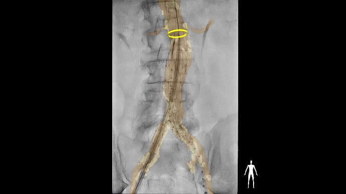 Contacto de la suite Vascular